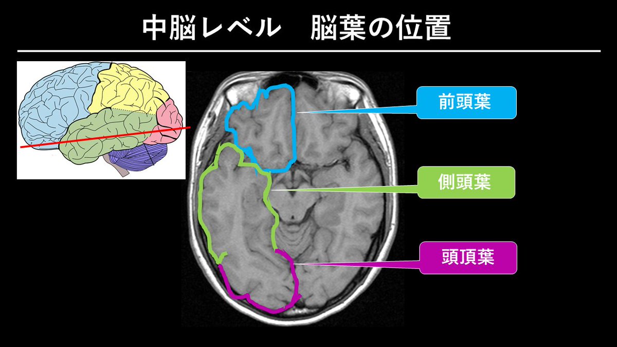 おはようございます。 🌈臨床で使える脳画像～脳葉編～ 脳は主に