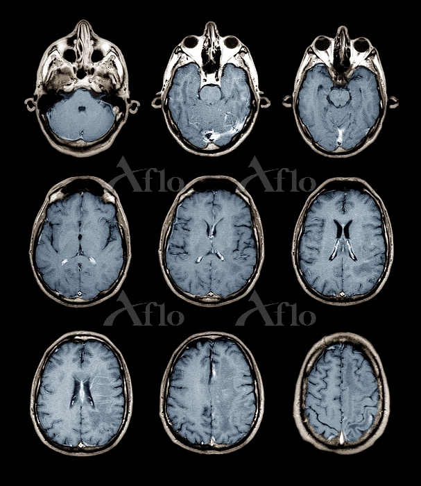 28歳の正常な脳のMRI [15598566]の写真素材 - アフロ