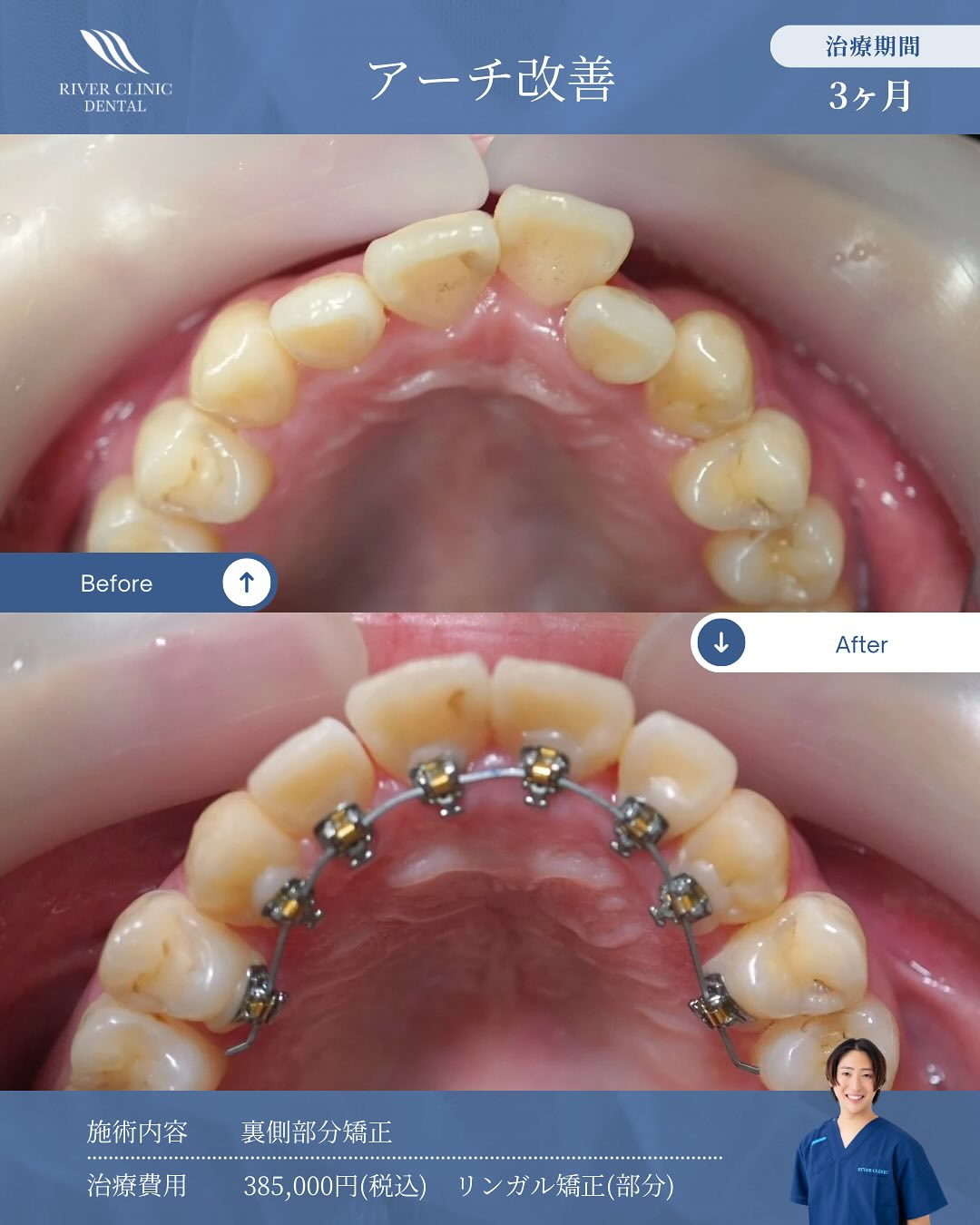 22リンガル矯正(アーチ改善) | RIVER CLINIC DENTAL 恵比寿