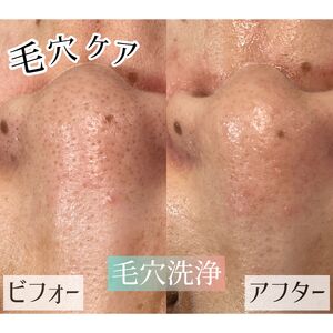 🫧毛穴洗浄ﾊｲﾄﾞﾛｽﾌﾟﾗｯｼｭ🫧 | 施術内容からご自宅でのケアまでご紹介