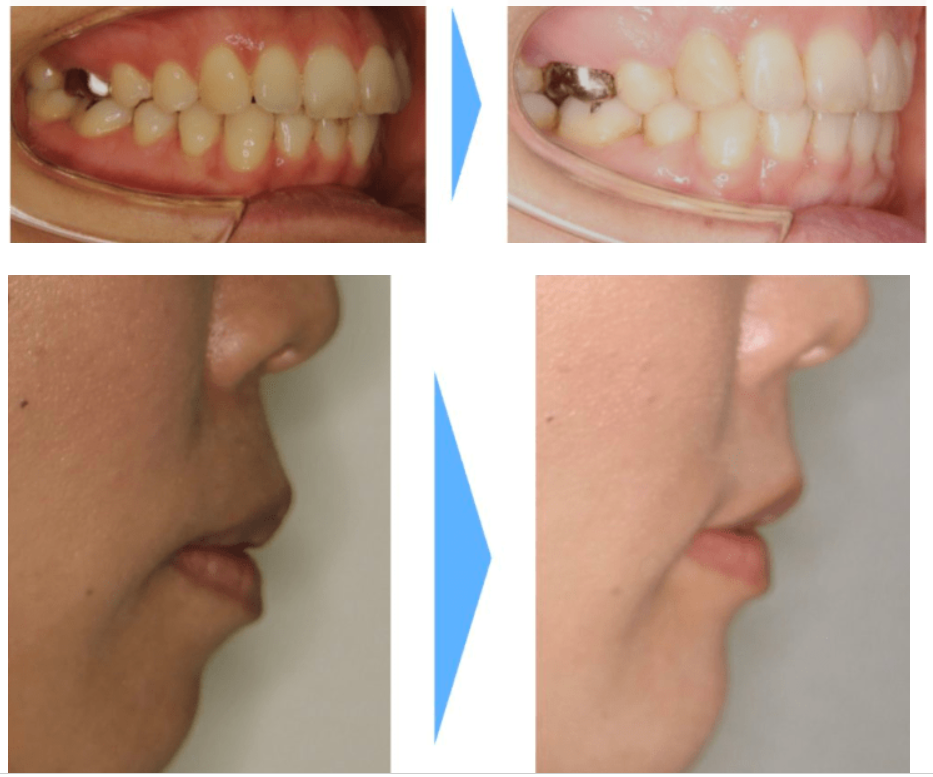 治療を開始する前に知っておきたいアライナー矯正で起こるトラブル例