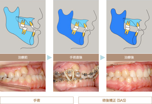 サージェリーファースト法 | 仙台青葉クリニック｜インプラント・矯正