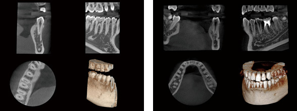 最新の歯科用CT｜最先端のCT撮影による安全で確実な歯科治療｜3D画像