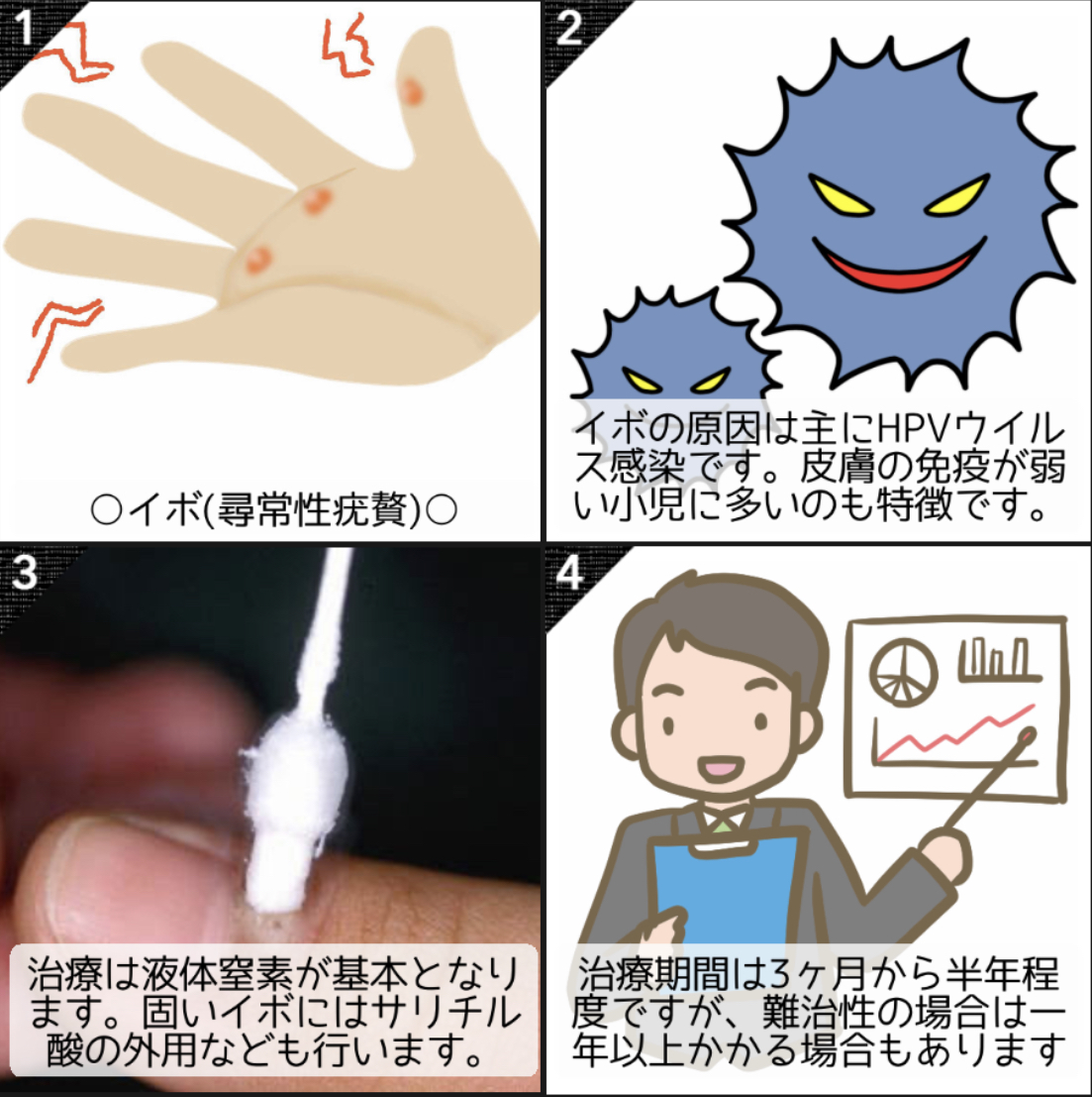 イボ | しらたま皮膚科クリニックららぽーと立川立飛|皮膚科|小児皮膚