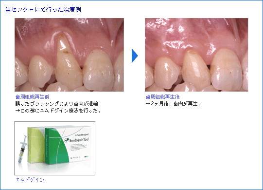 歯周組織再生治療｜スウェーデン デンタルセンター