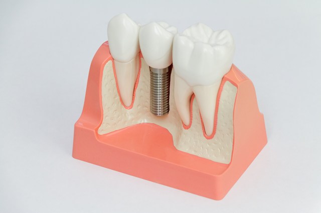 インプラント | 江東区北砂の歯医者【砂町北歯科】歯周病・根管治療