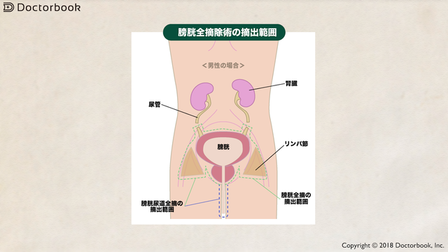 医師出演】膀胱がんの治療における膀胱全摘術と尿路変向術の2つの方法