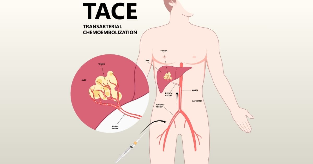 肝臓がんは動脈内化学療法で治療できます | Bangkok Cancer Hospital