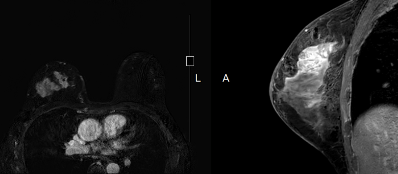 Breast MRI 乳房の診断に用いる磁気共鳴イメージング（Magnetic